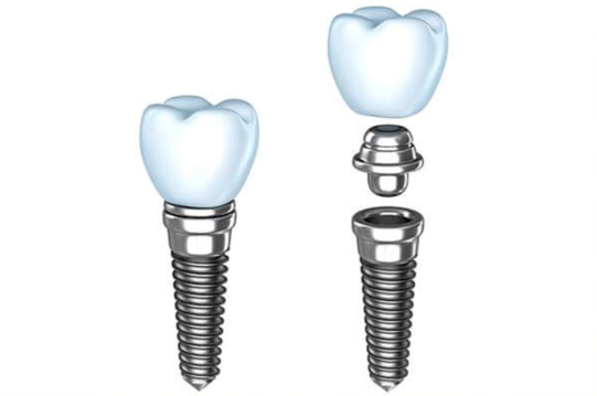 Single Tooth Implant
